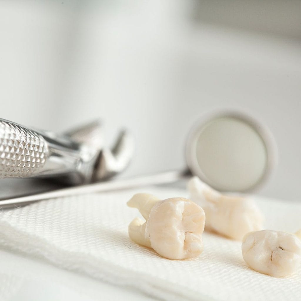 Chirurgia orale 1 Estrazione dente del giudizio a Vicenza