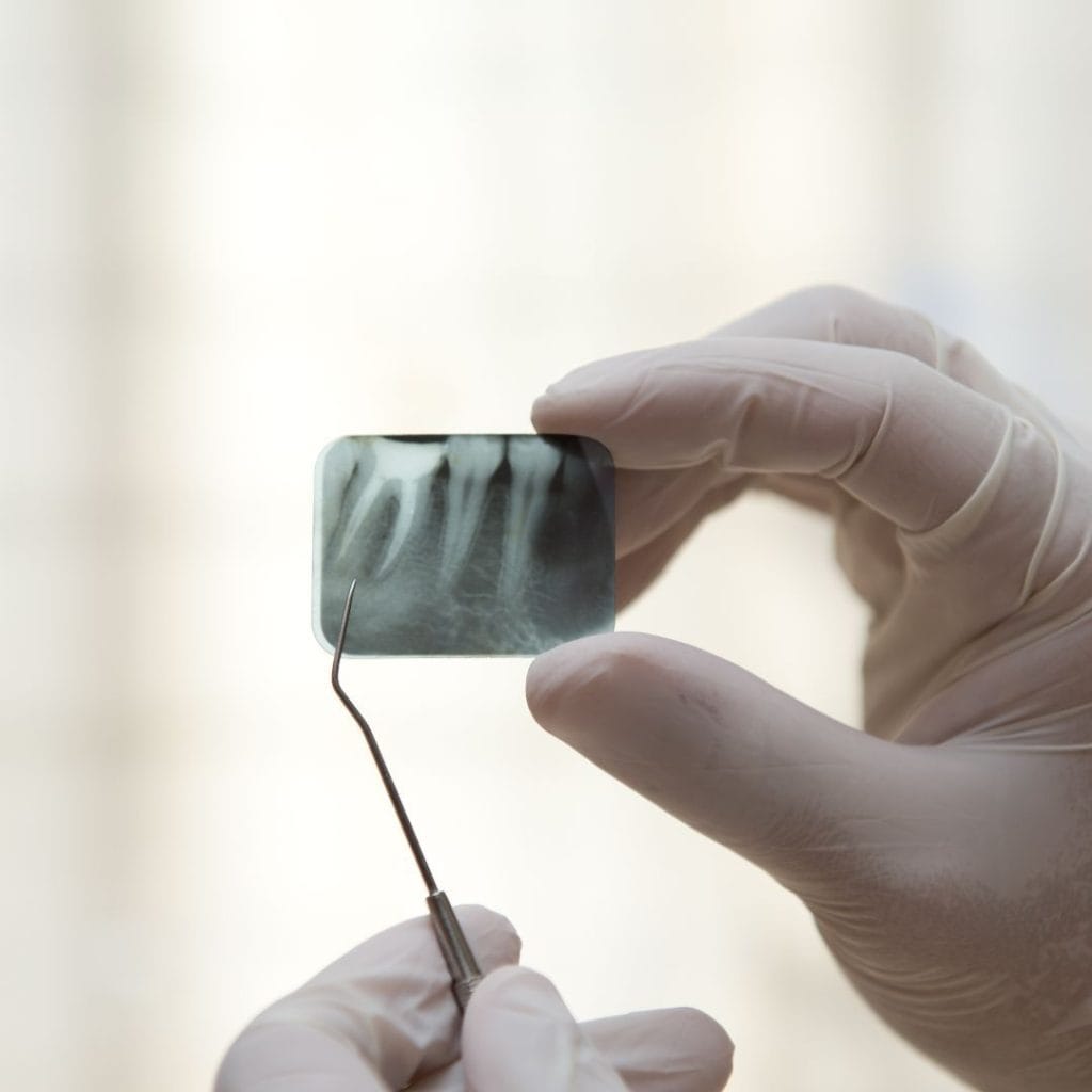 Endodonzia 1 Devitalizzazione dente a Vicenza