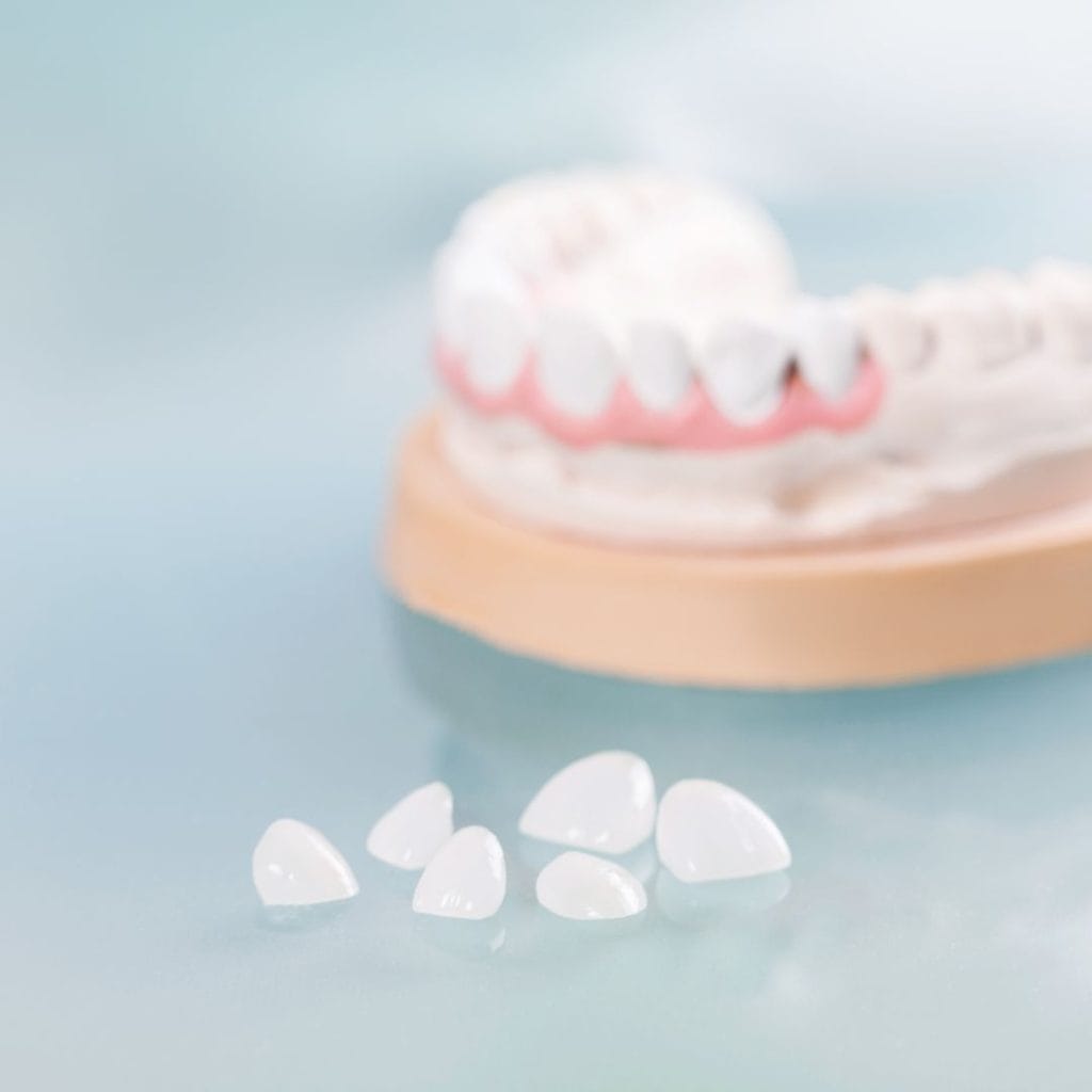 Faccette Dentali 1 Faccette dentali a Vicenza