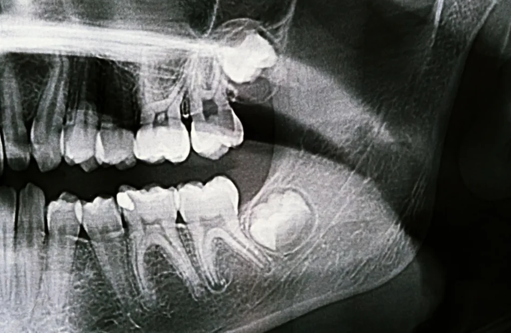È doloroso togliere un dente del giudizio? 1 dente del giudizio estrazione