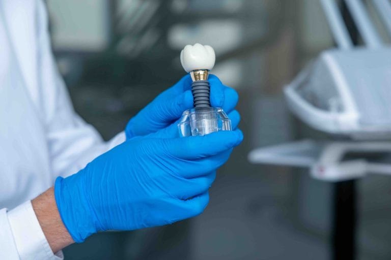 Blog 3 Impianto dentale come funziona