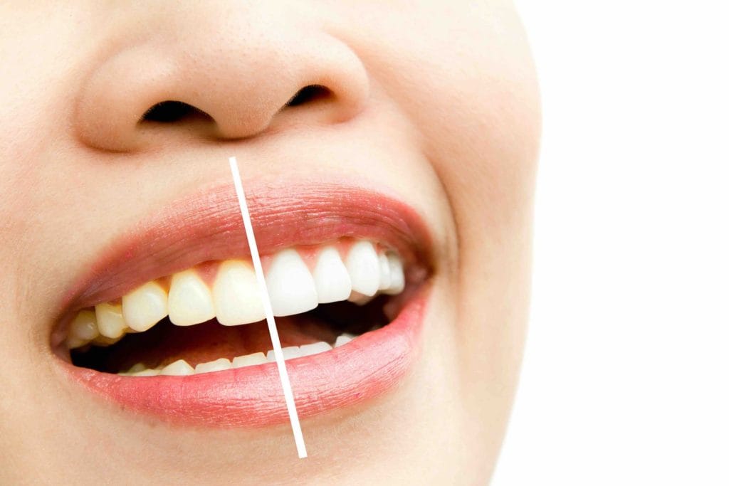Come funziona lo sbiancamento denti dal dentista 1 Come funziona lo sbiancamento denti